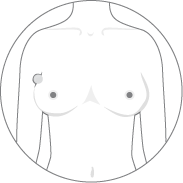 Lumps in the armpit (axilla)