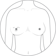 Lump in the breast
