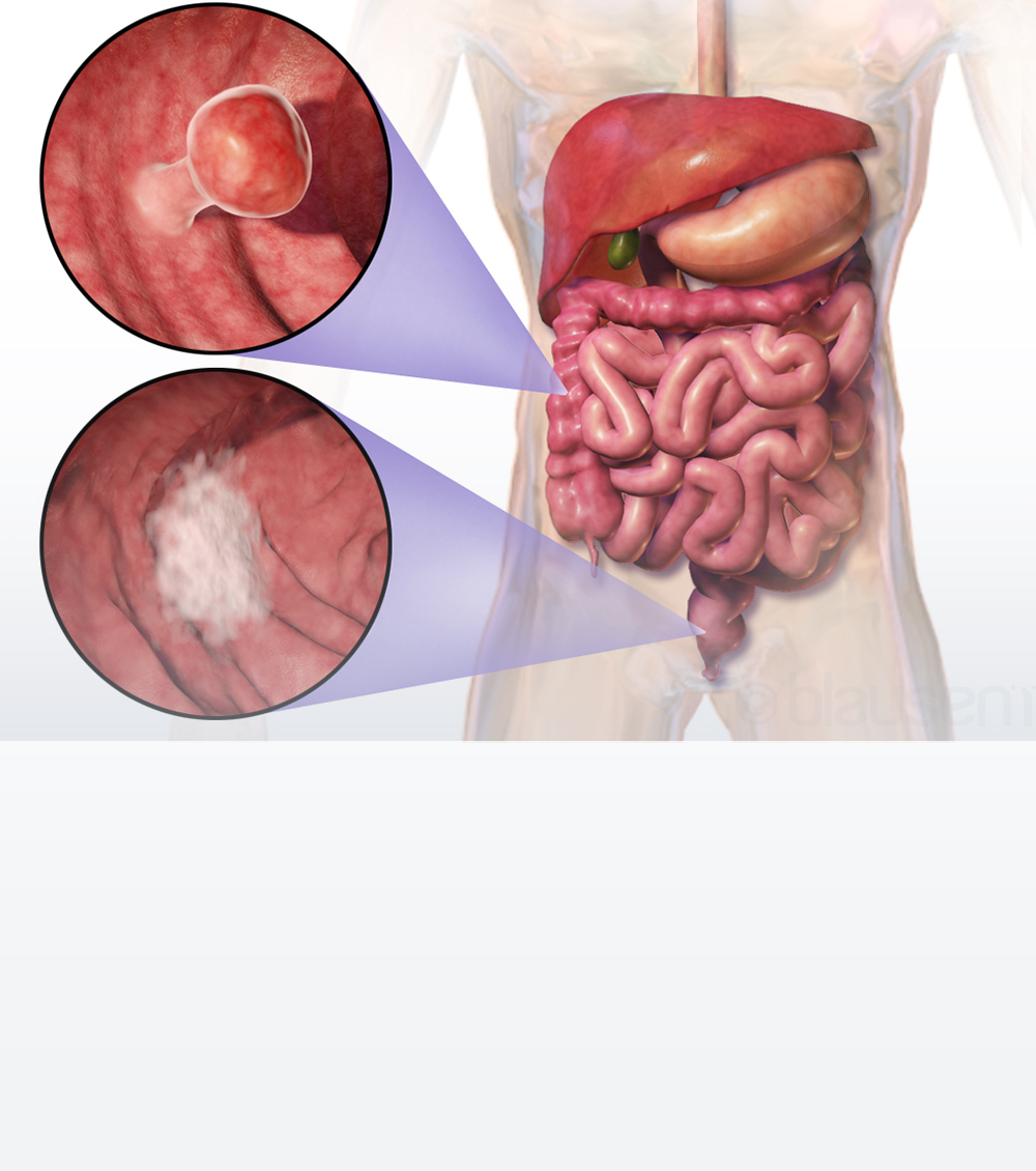 https://thangamcancercenter.com/file/wp-content/uploads/2023/10/Causes-of-Colorectal-Cancer-1.jpg