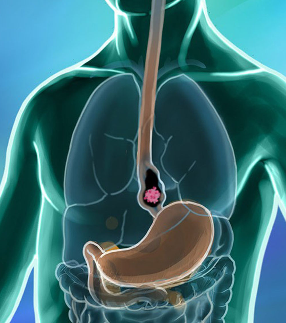 https://thangamcancercenter.com/file/wp-content/uploads/2023/10/Esophagus-Cancer-Treatment.jpg