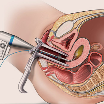 https://thangamcancercenter.com/file/wp-content/uploads/2023/10/Hysteroscopy-1.jpg