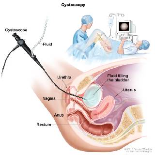 https://thangamcancercenter.com/file/wp-content/uploads/2023/10/cystoscopy-1.jpg