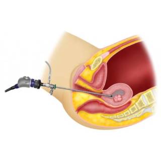 https://thangamcancercenter.com/file/wp-content/uploads/2023/10/hysteroscopy-2.jpg