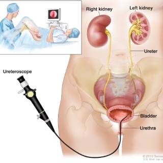 https://thangamcancercenter.com/file/wp-content/uploads/2023/10/urecteroscopy.jpg