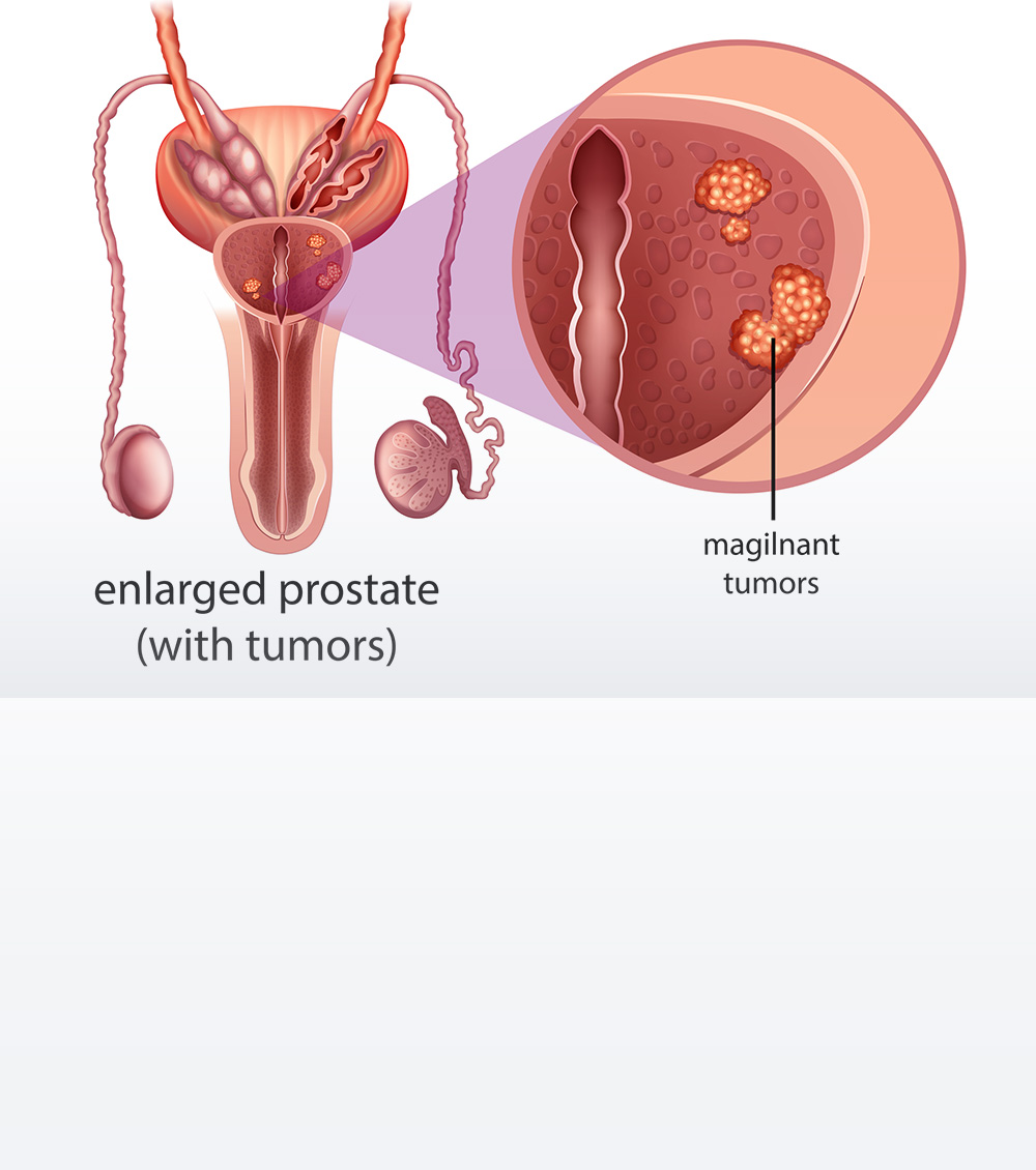 https://thangamcancercenter.com/file/wp-content/uploads/2023/11/Causes-of-Prostate-Cancer.jpg