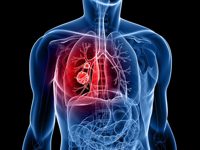 https://thangamcancercenter.com/file/wp-content/uploads/2023/11/Lung-Cancer-1.jpg