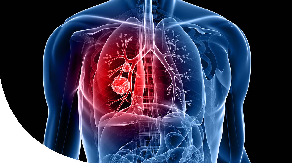 https://thangamcancercenter.com/file/wp-content/uploads/2023/11/Lung-Cancer.jpg