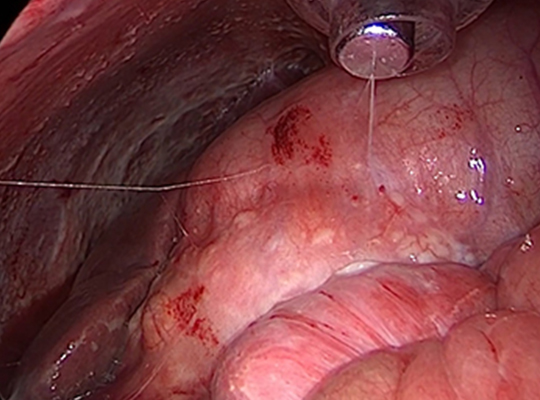 https://thangamcancercenter.com/file/wp-content/uploads/2023/11/Peritoneal-Surface-Oncology-Unit.jpg