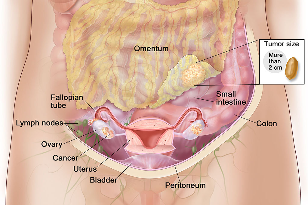 https://thangamcancercenter.com/file/wp-content/uploads/2023/11/Treatment-of-Peritoneal-surface-malignancies.jpg