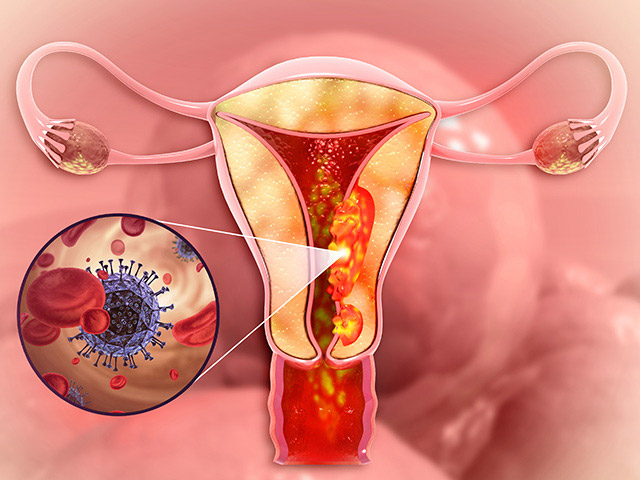 https://thangamcancercenter.com/file/wp-content/uploads/2024/07/Endometrial-Cancer-1.jpg