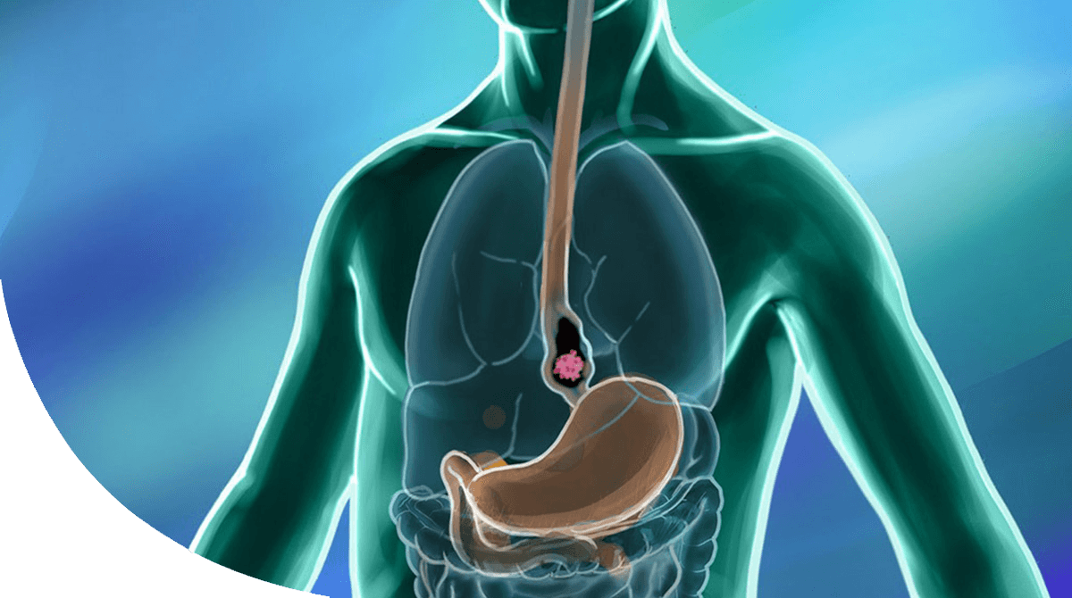 https://thangamcancercenter.com/file/wp-content/uploads/2024/07/Esophagus-Cancer.png