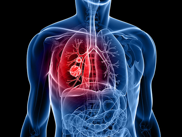 https://thangamcancercenter.com/file/wp-content/uploads/2024/07/Lung-Cancer-1-1.jpg