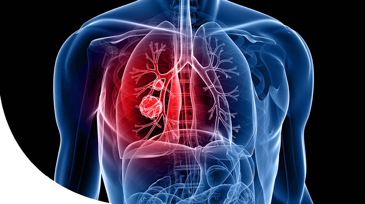 https://thangamcancercenter.com/file/wp-content/uploads/2024/07/Lung-Cancer.png