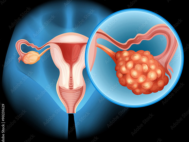 https://thangamcancercenter.com/file/wp-content/uploads/2024/07/Ovarian-Cancer.jpg