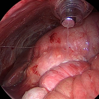 https://thangamcancercenter.com/file/wp-content/uploads/2024/07/PIPAC-Peritonial-Surface-Malignancy.jpg