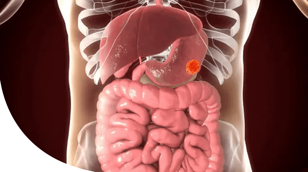 https://thangamcancercenter.com/file/wp-content/uploads/2024/07/Stomach-Cancer-1.png