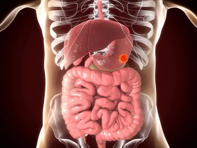 https://thangamcancercenter.com/file/wp-content/uploads/2024/07/Stomach-Cancer-2.jpg