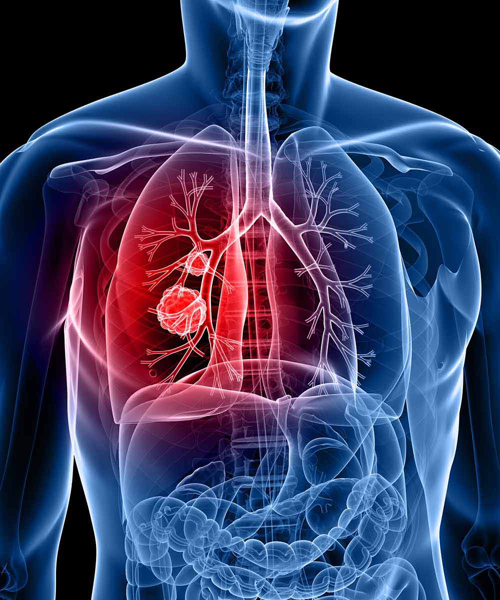 https://thangamcancercenter.com/file/wp-content/uploads/2024/07/Treatment-for-Lung-Cancer.jpg