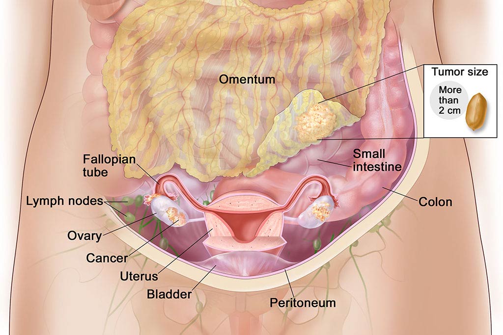 https://thangamcancercenter.com/file/wp-content/uploads/2024/07/Treatment-of-Peritoneal-surface-malignancies.jpg