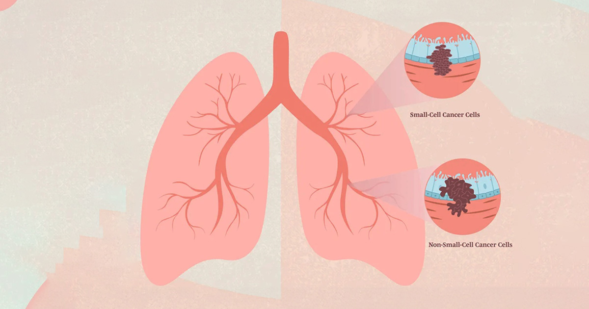 Small Cell vs Non-Small Cell Lung Cancer Treatment
