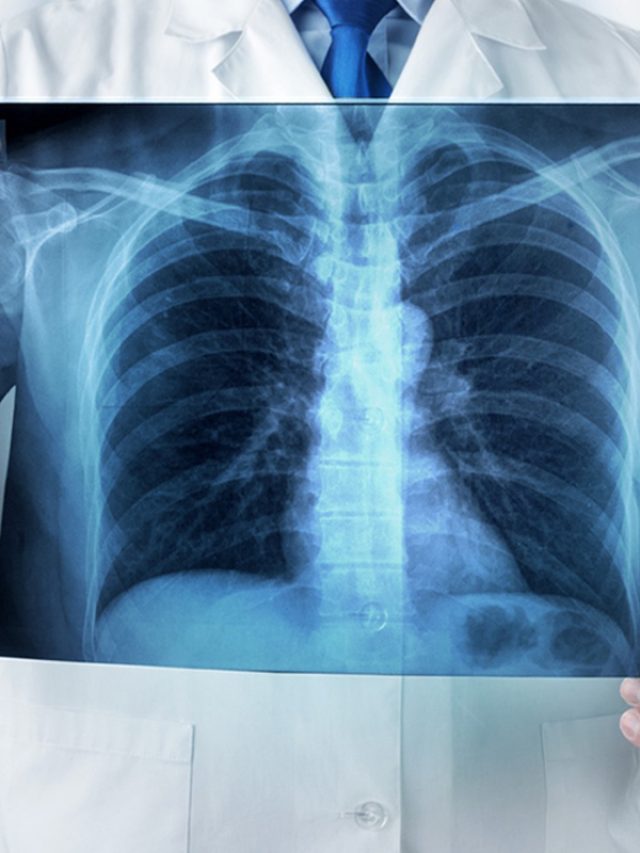 How Lung Cancer is Diagnosed: From Scan to Biopsy