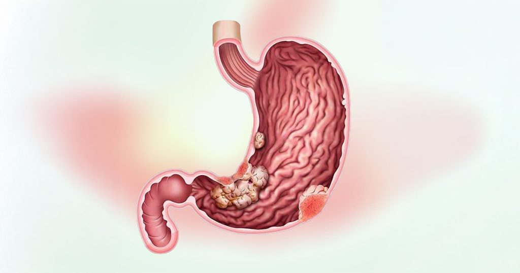 Stomach Cancer Stages: Symptoms, Diagnosis & Treatment
