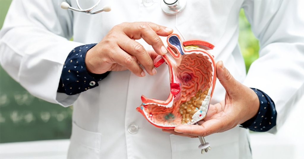 Early Signs and Symptoms of Stomach Cancer