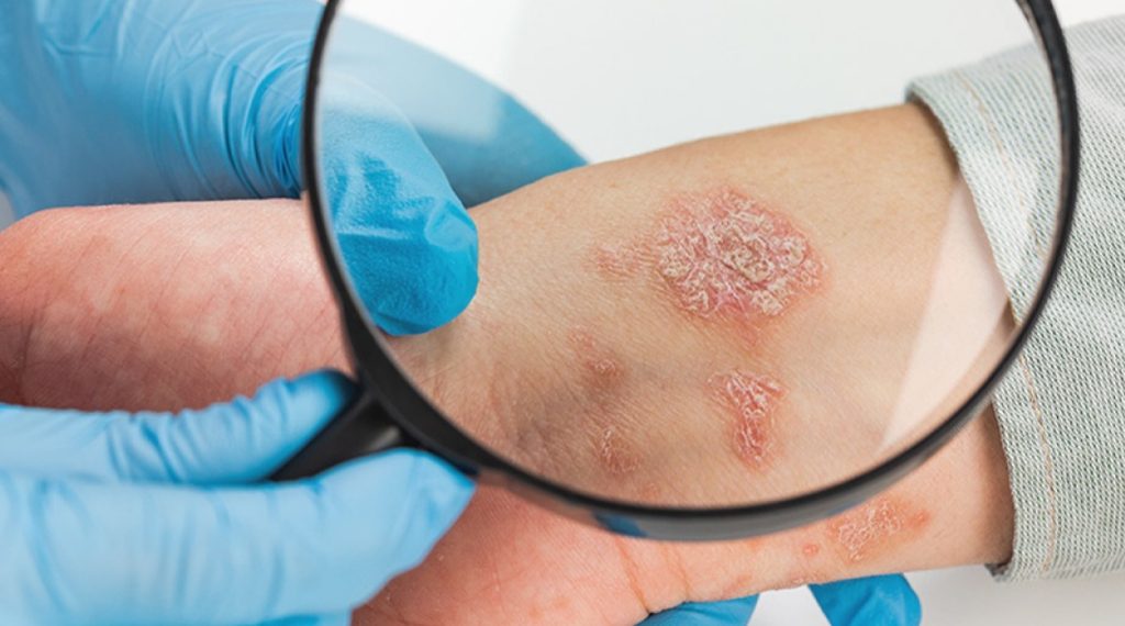 What Is Skin Cancer? Types, Causes and Early Signs​