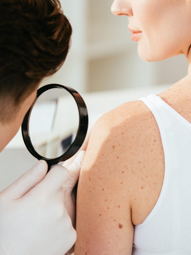 Early Signs of Skin Cancer You Shouldn’t Ignore