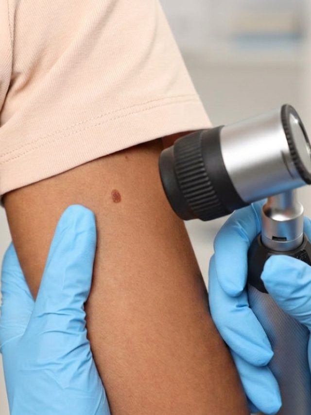 Skin Cancer Treatment Options Explained Simply