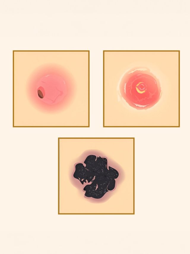 Types of Skin Cancer: Melanoma vs non-melanoma