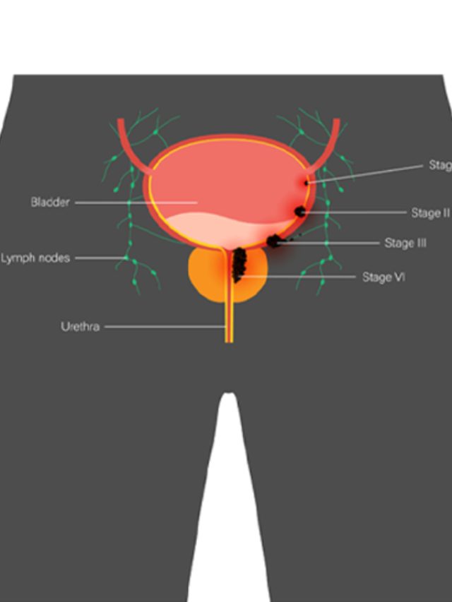 Stages of Prostate cancer